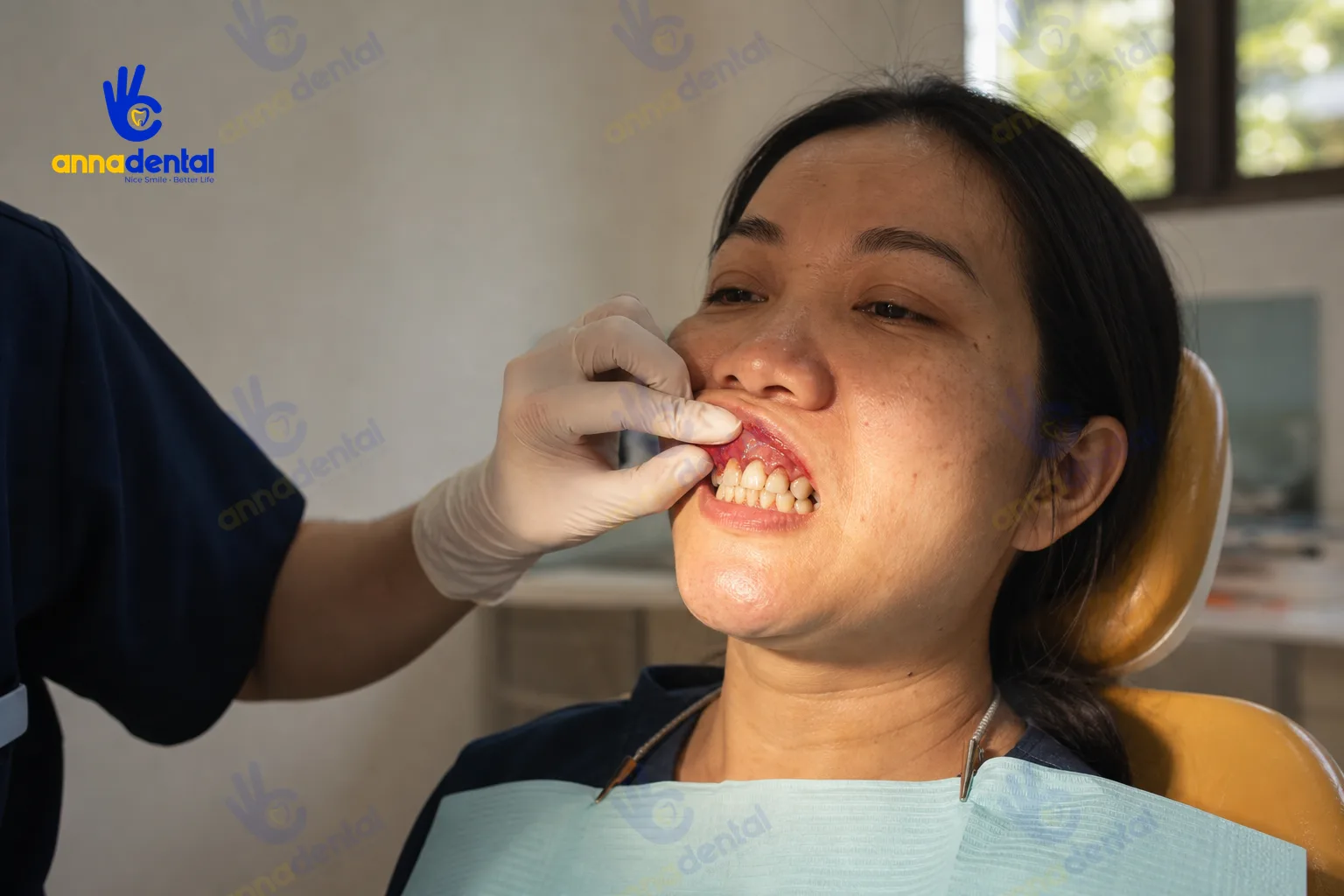 Bệnh nhân cho thấy dấu hiệu viêm nha chu rõ ở nướu bị sưng đỏ