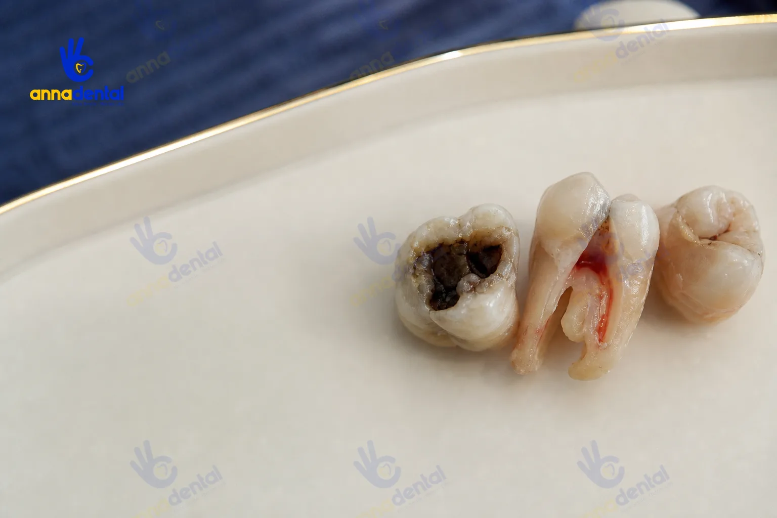 Răng sâu, nứt vỡ và gãy do nhiều nguyên nhân gây viêm tủy