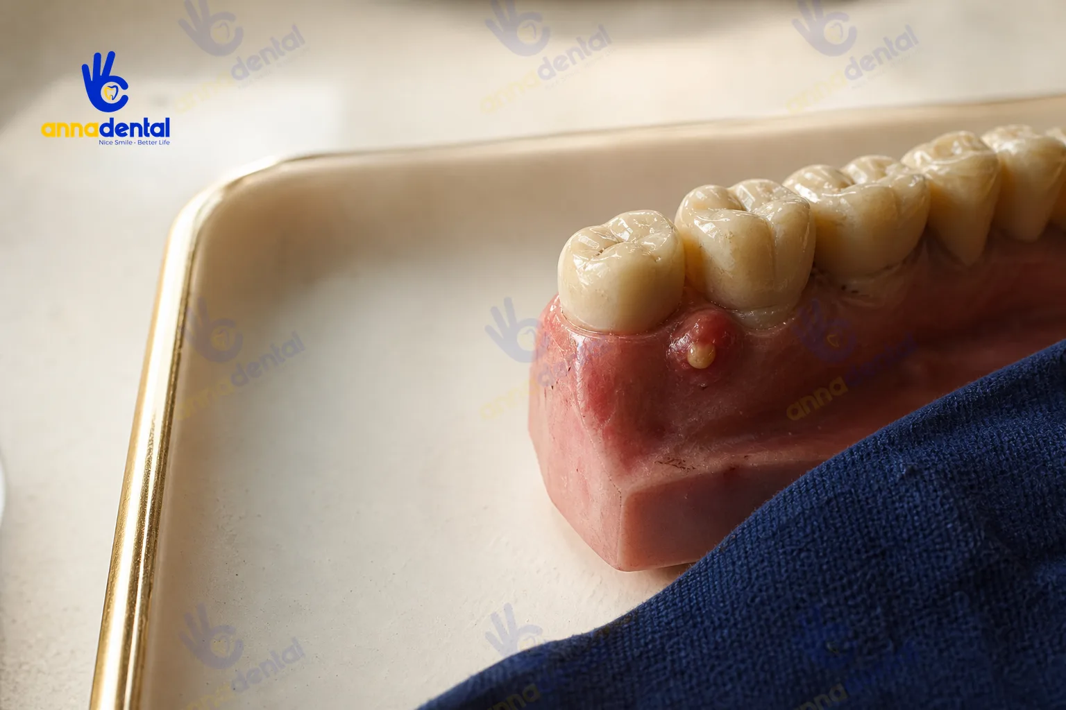 Mô hình răng mô phỏng viêm tủy và sưng áp-xe đầu chân răng